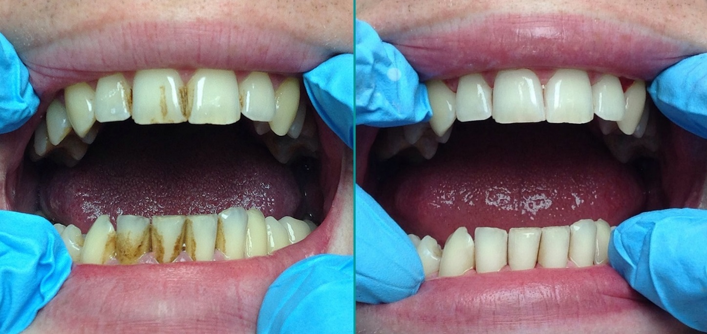 Гигиеническая чистка зубов Томск Ламповый стоматология с острой болью круглосуточно томск